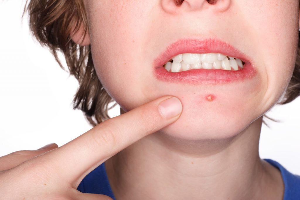 Everything-You-Need-To-Know-About-Acne